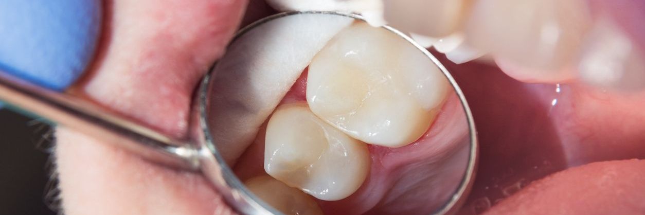 Zahnfüllungen